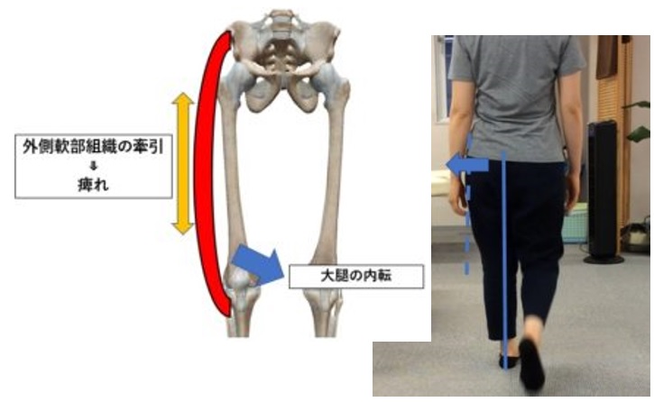 太もも 大腿 の外側の痛み ダルさでお困りの方へ とよあけ接骨院ケア