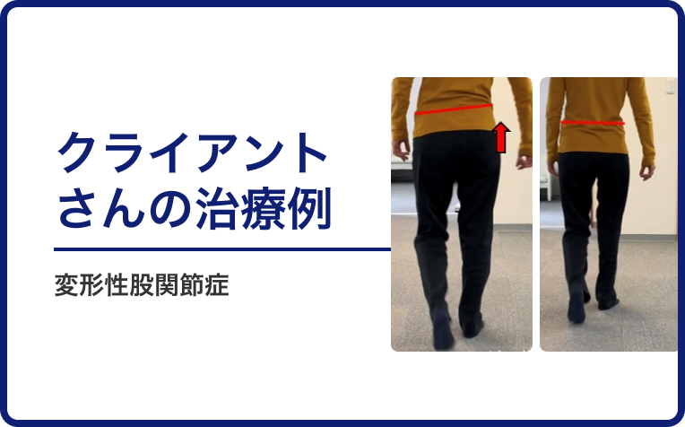 変形性股関節症のクライアントさんの治療例