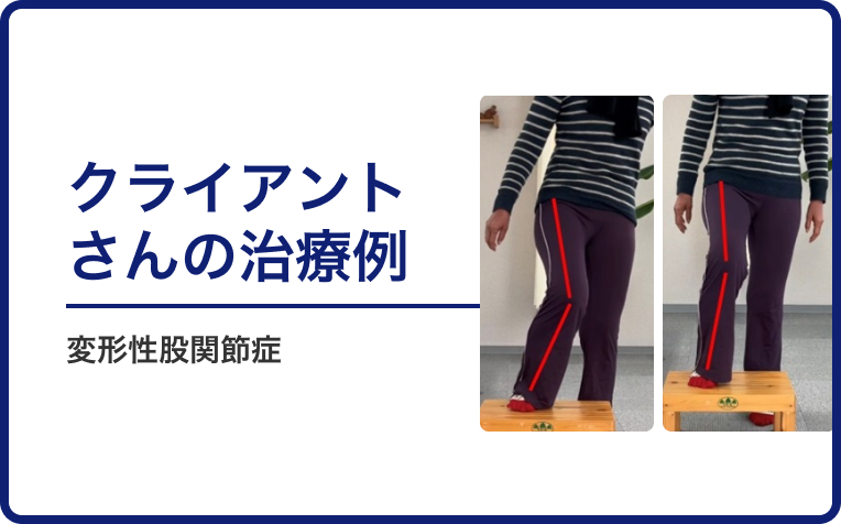 変形性股関節症のクライアントさんの治療例