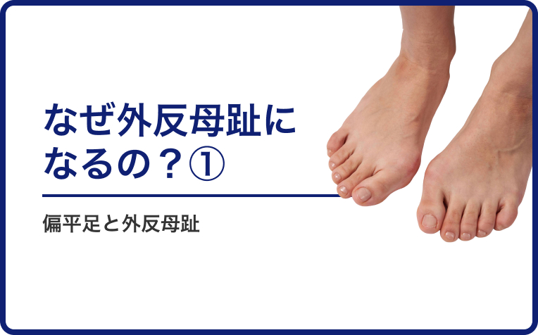なぜ外反母趾になるの？①「偏平足と外反母趾」