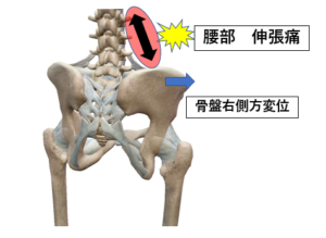 近く 痛み 骨盤 右 の 右，骨盤のすぐ上の痛み