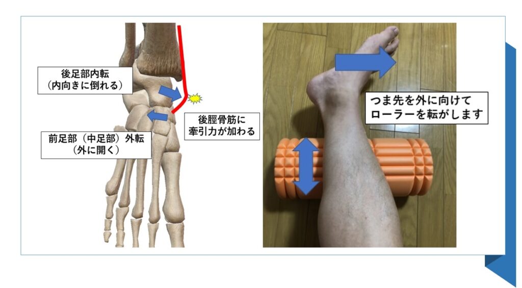 有痛性外脛骨・外脛骨障害でお困りの方へ。
