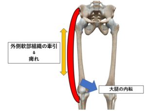 太もも 大腿 の外側の痛み ダルさでお困りの方へ とよあけ接骨院ケア