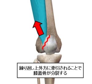 成長期の膝の痛み 有痛性分裂膝蓋骨 でお困りの方へ Hk Labo