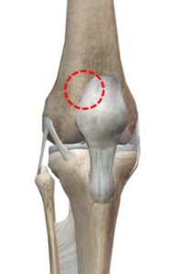 成長期の膝の痛み 有痛性分裂膝蓋骨 でお困りの方へ とよあけ接骨院ケア