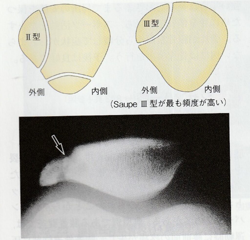 有痛性分裂膝蓋骨とは