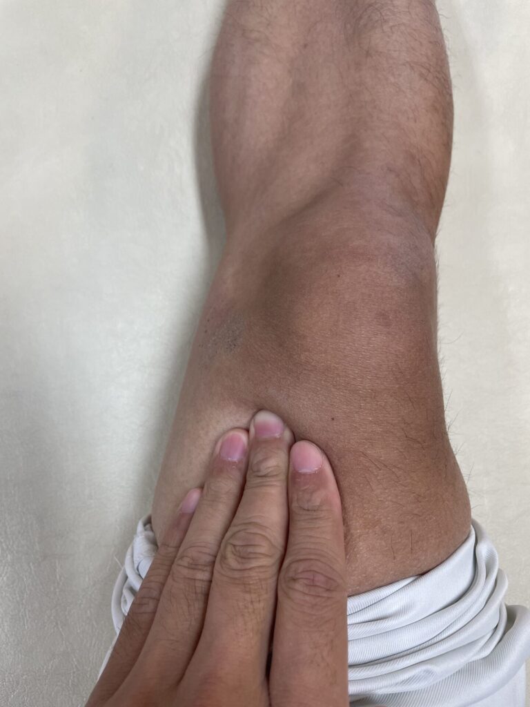 有痛性分裂膝蓋骨の治療法（筋膜リリース）②