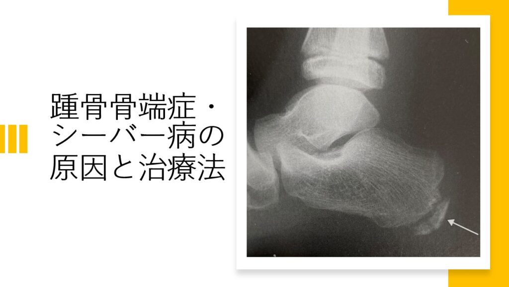 踵骨骨端症（シーバー病・セーバー病）の原因と治療法 - HK LABO