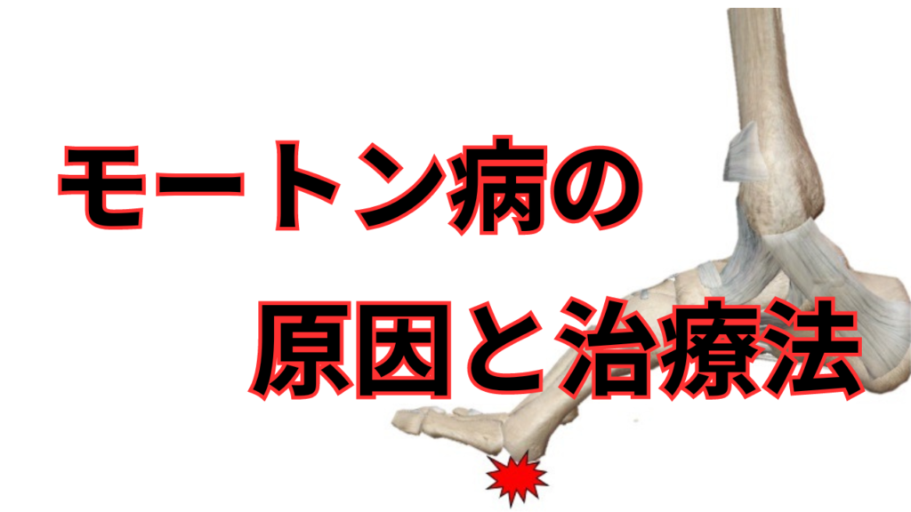 足裏の痛み「モートン病」の原因と治療法